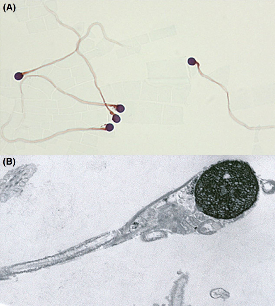 afbeelding (kleur) Zaadcellen van een man met globozoöspermie
