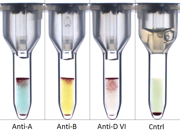 Figuur (kleur) ABD-bepaling  mixed field reactie bij AG bepaling.